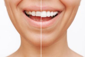Smiling woman showing before and after results of teeth whitening treatment, illustrating the effectiveness of professional dental care.
